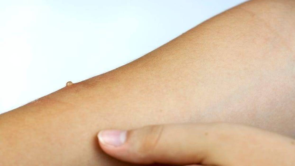 Measles on arm