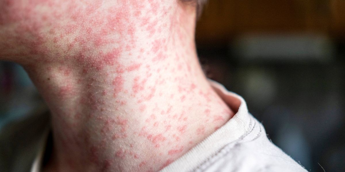 State logs first measles case in 2026