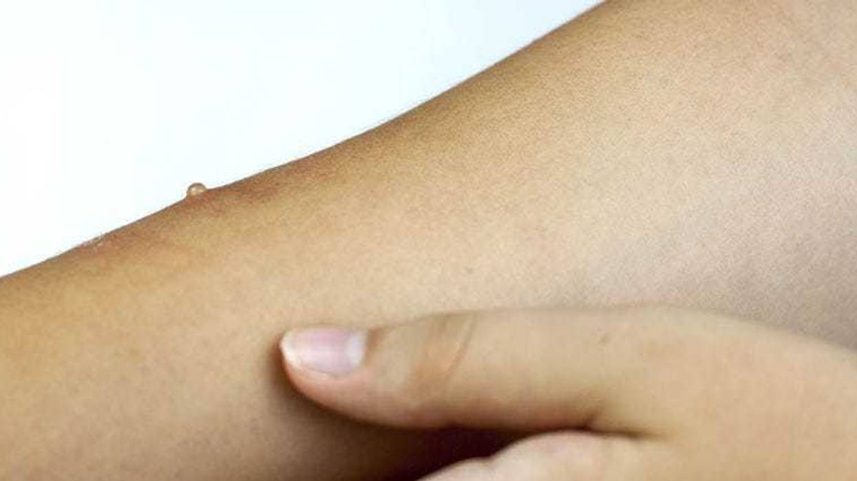Measles