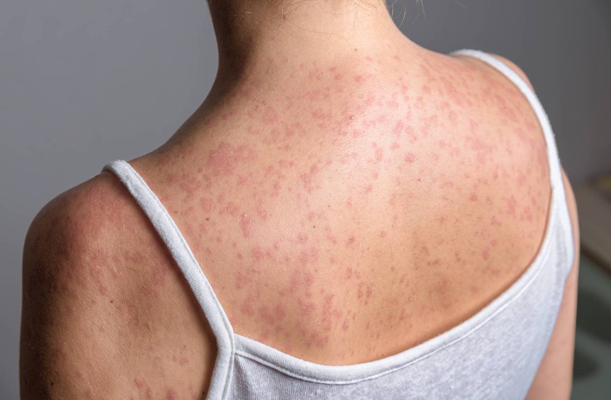 measles