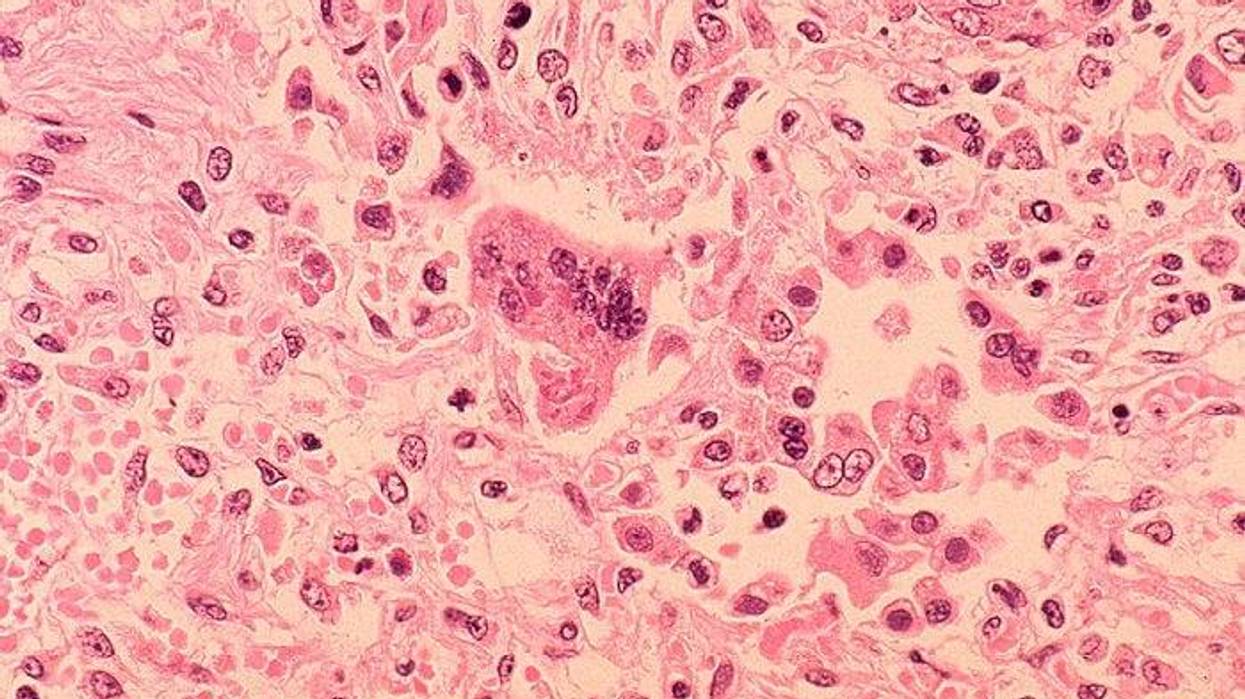 measles