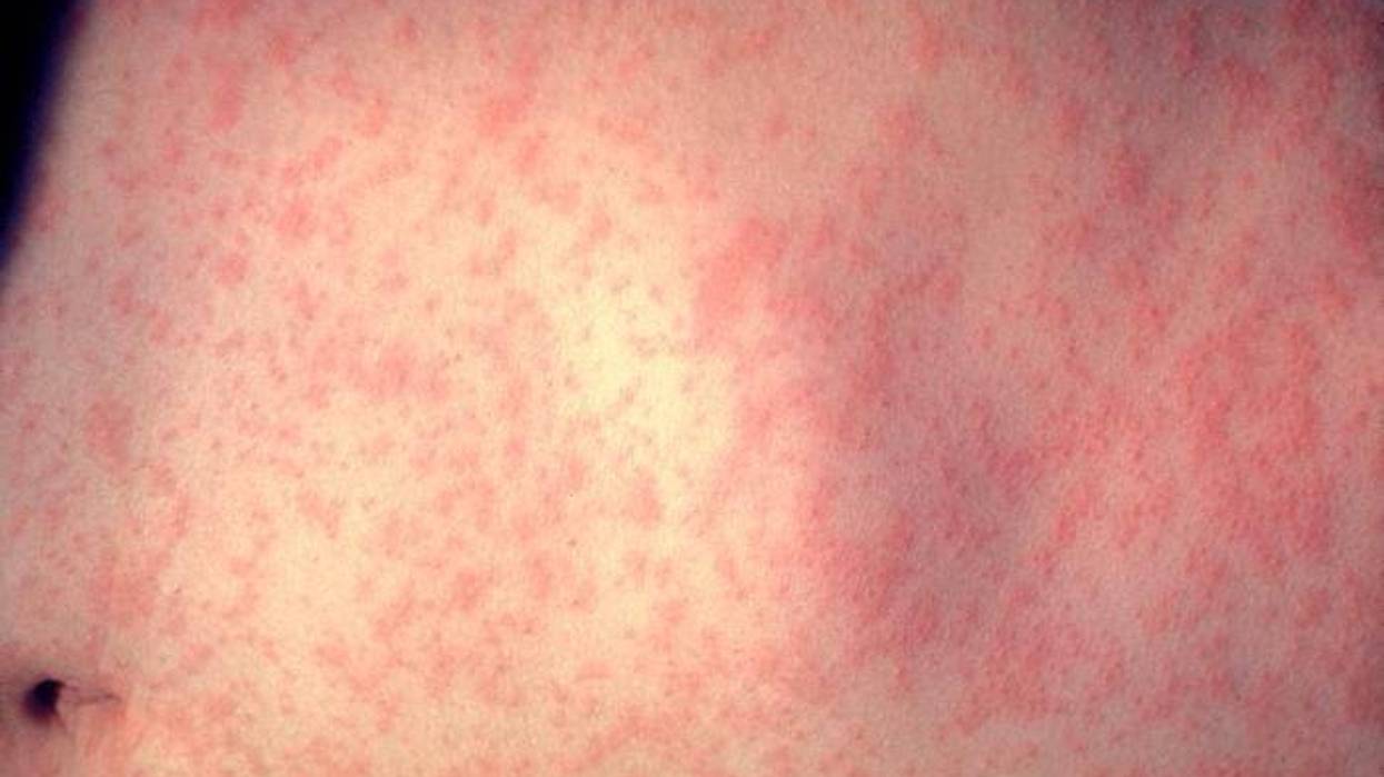 measles