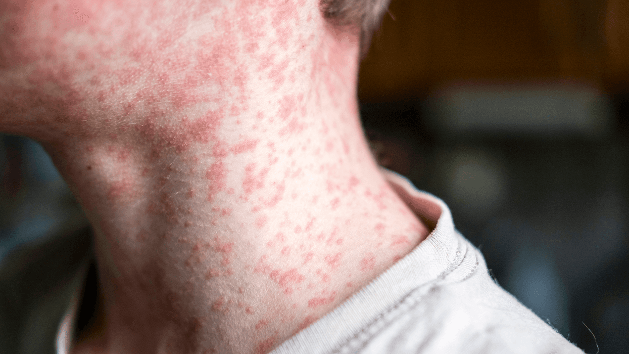 Measles