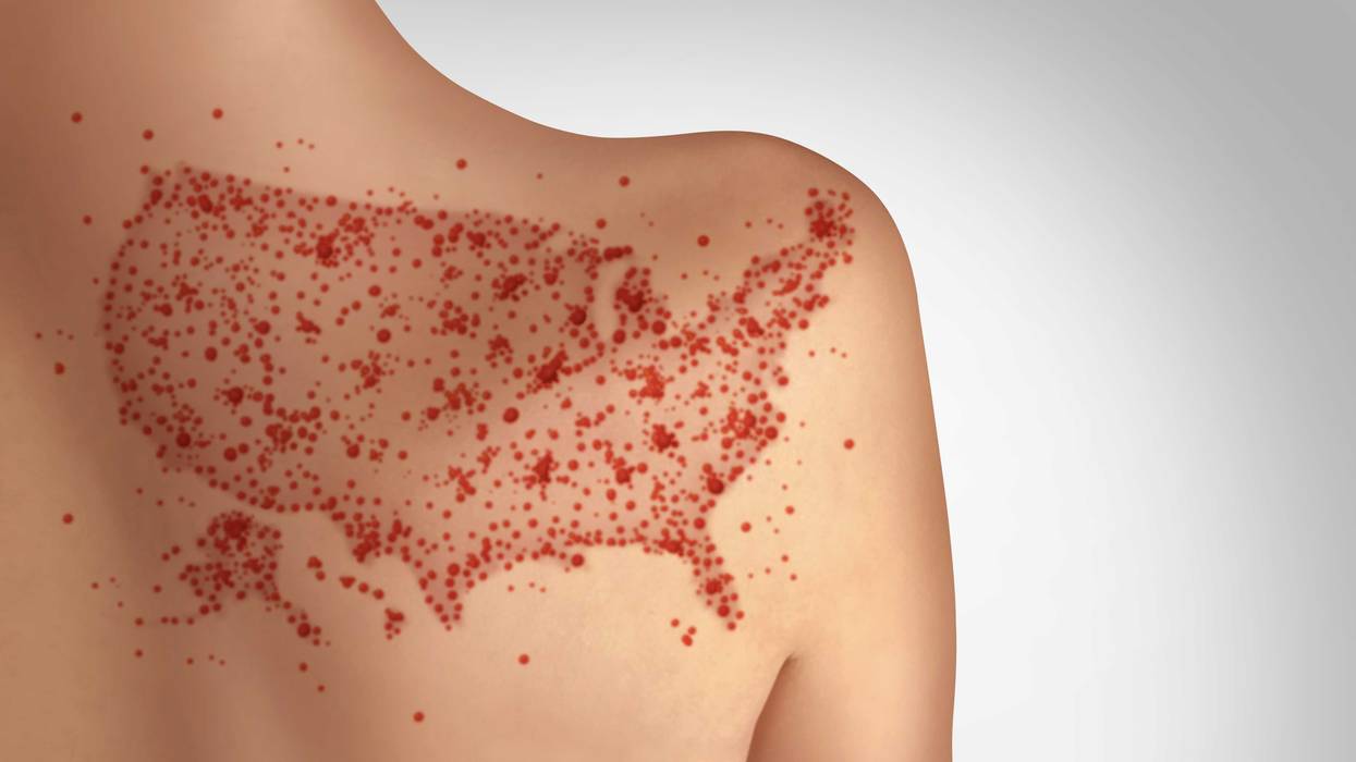 Minnesota has one of the worst measles vaccination rates among young children in the country and the state is planning to use wastewater testing to better track the virus.