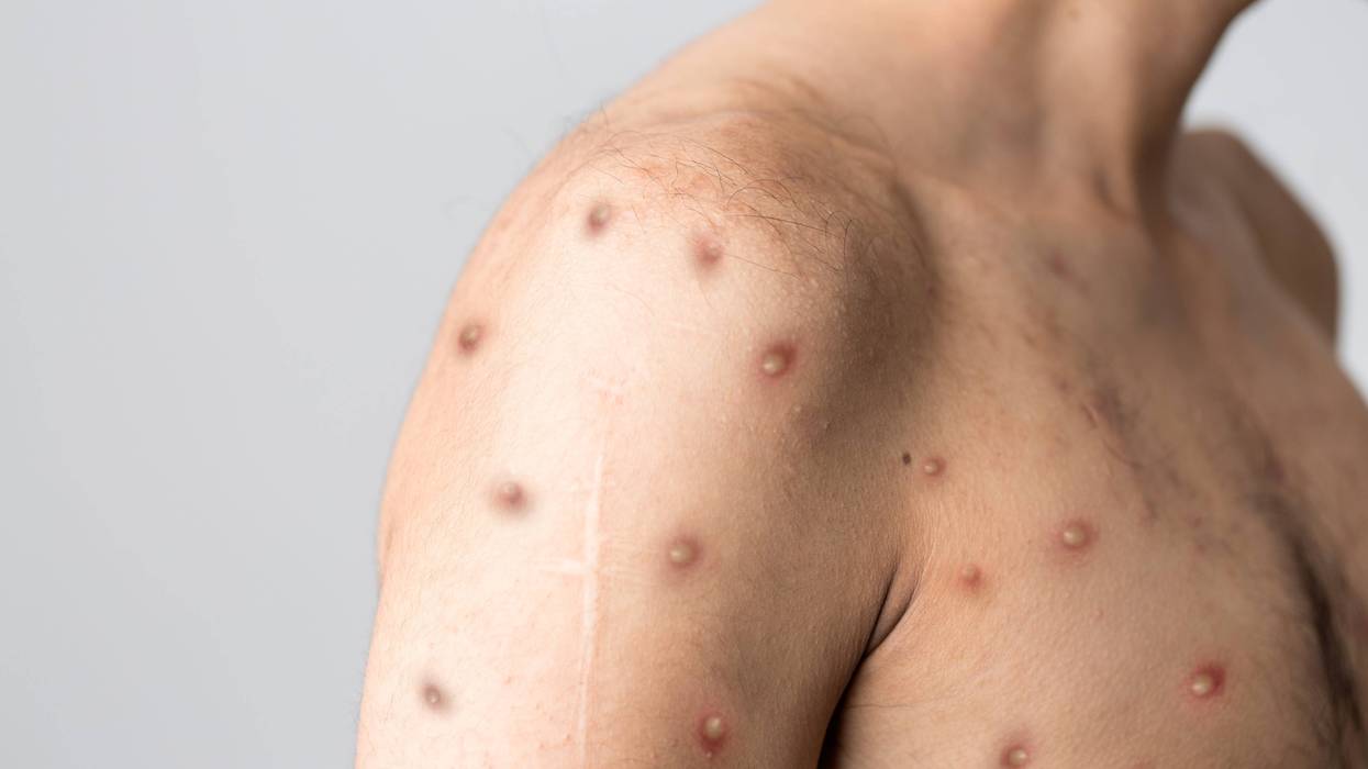 monkeypox