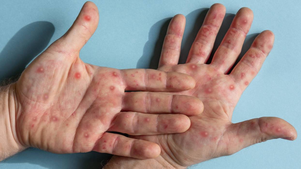 Monkeypox