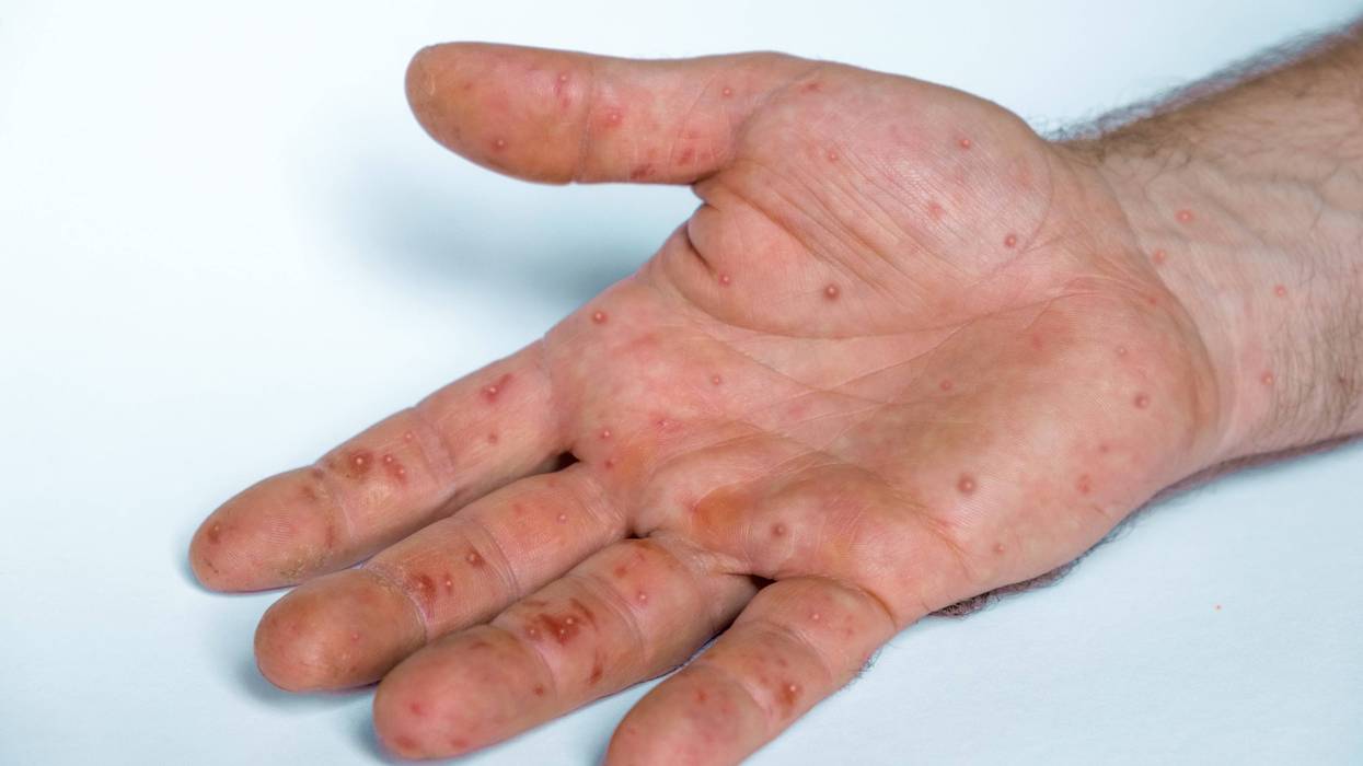 Monkeypox