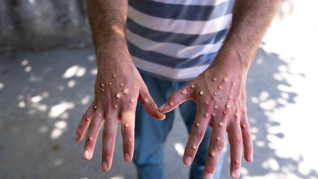 Monkeypox