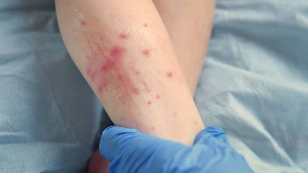 PA Measles Outbreak Surges Past 490 Cases Following Record August Spikes