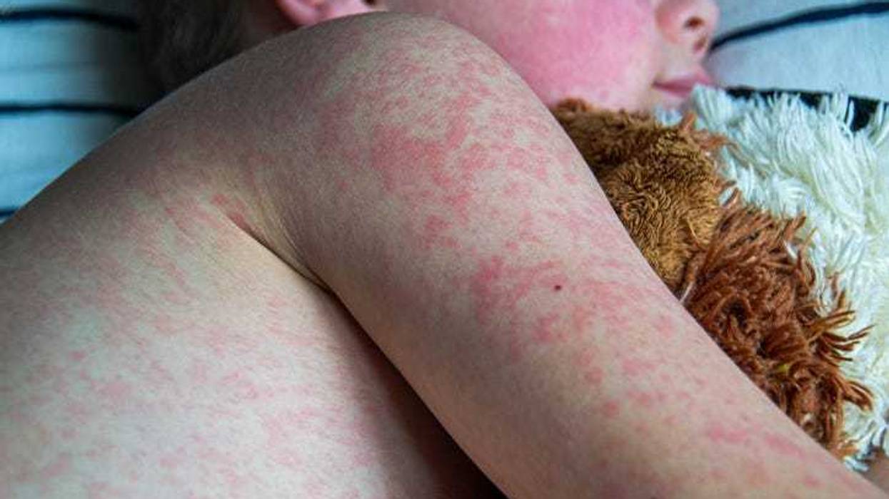 Pennsylvania Measles Outbreak Surges Past 590 Cases