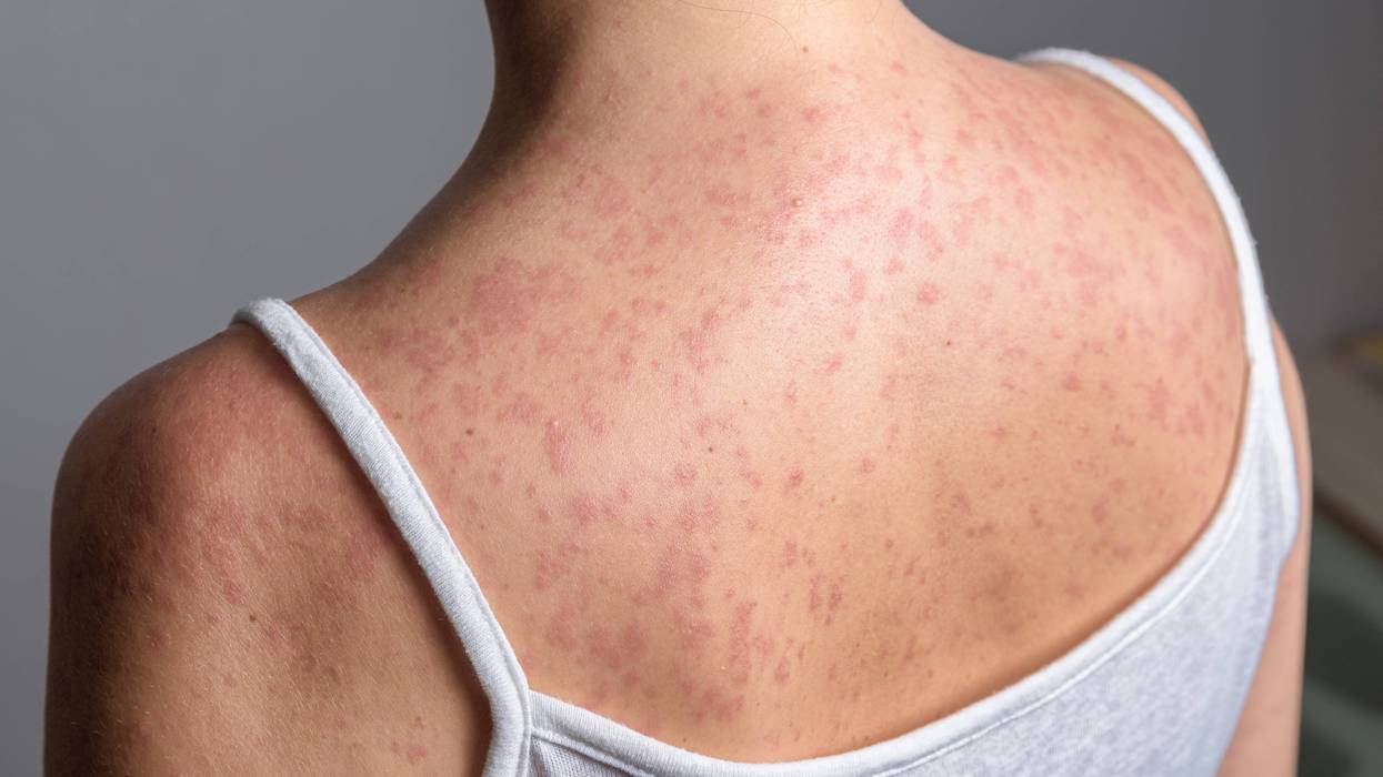 Pennsylvania Reports First Measles Deaths in 35 Years Amid Statewide Outbreak