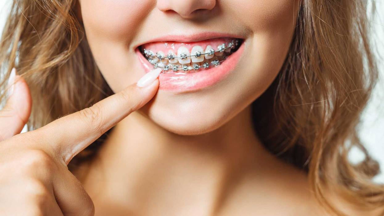 Person with braces stock photo.