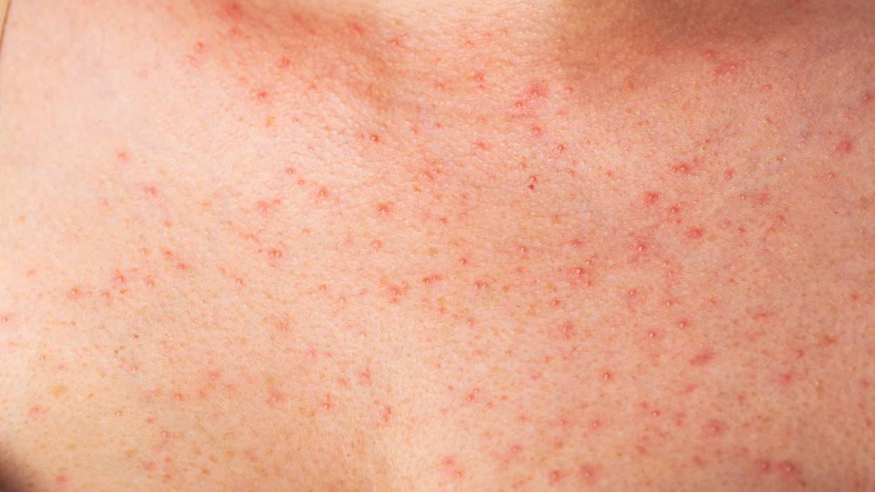 Red pimples and rashes on female skin. Concept of chronic dermatological diseases, allergy to drugs, eczema