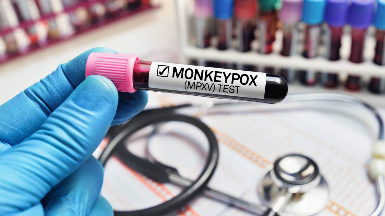 San Francisco health officials announced the first probable case of monkeypox has been identified in a resident through testing at a California Department of Public Health laboratory.
