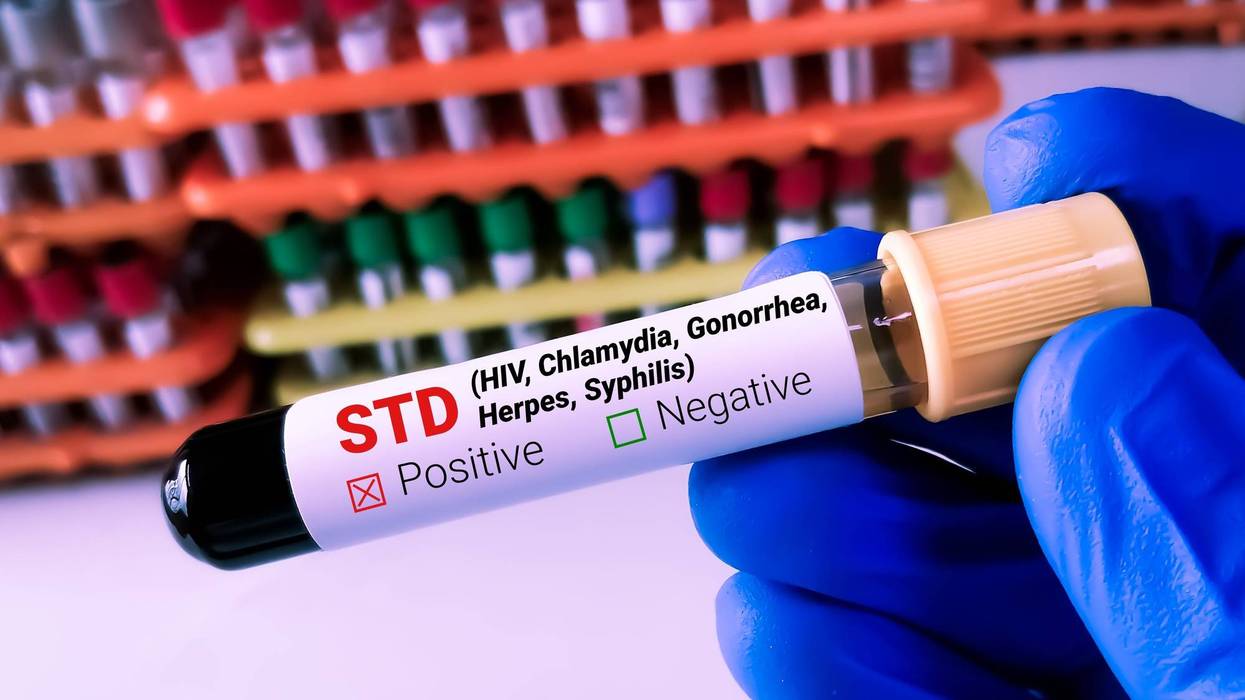 STD test to look for abnormalities from blood, blood sample to analyze in the laboratory, blood in test tube