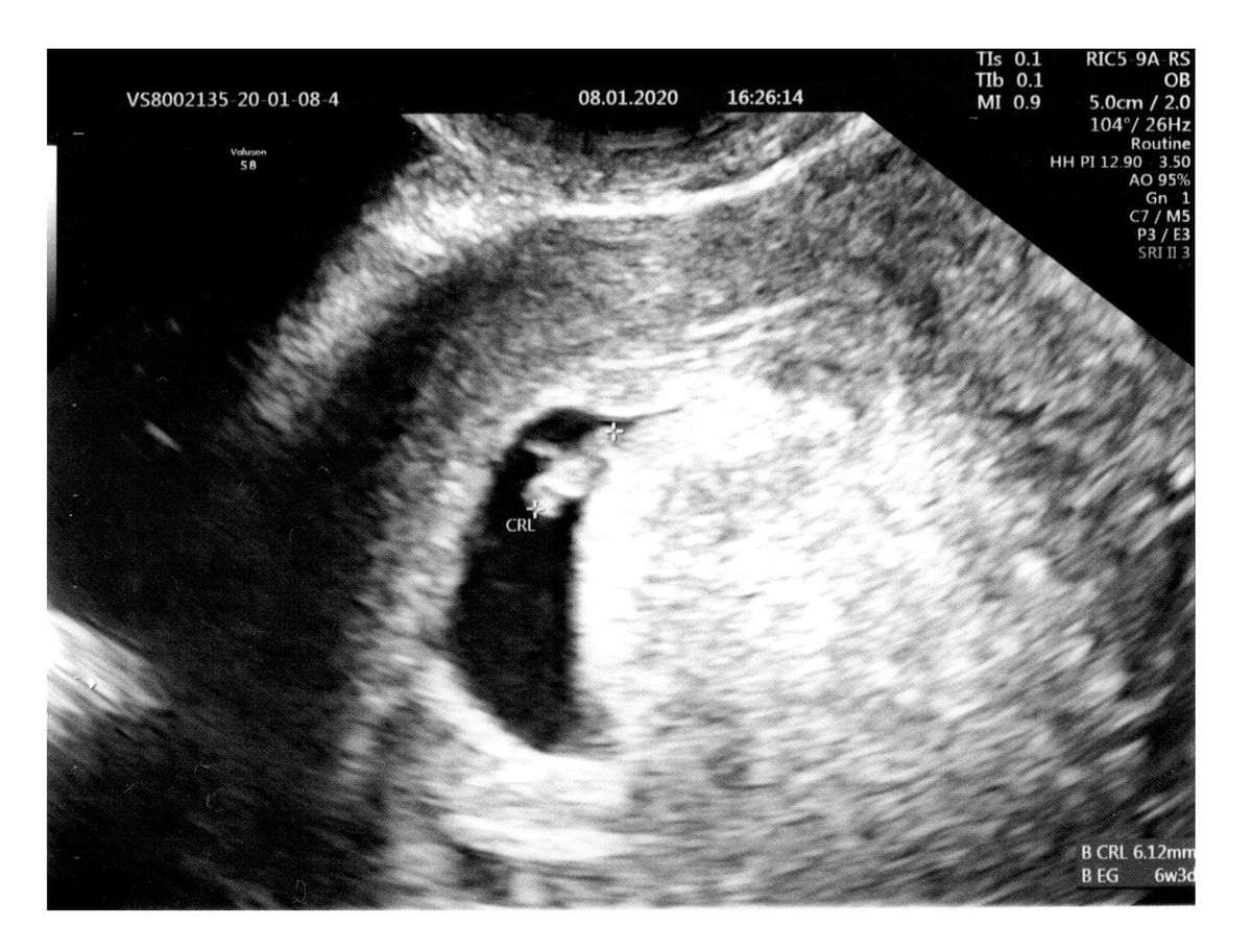 Stock 6-8 week ultrasound scan.