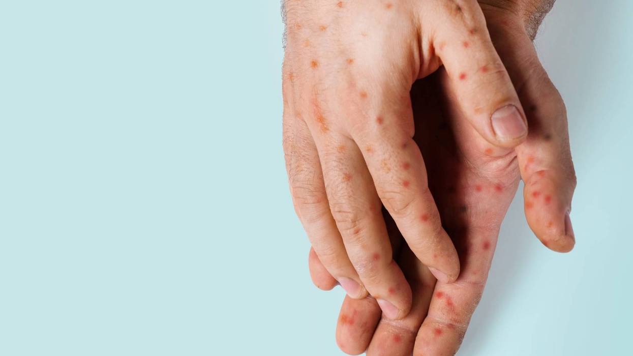 Stock photo - measles