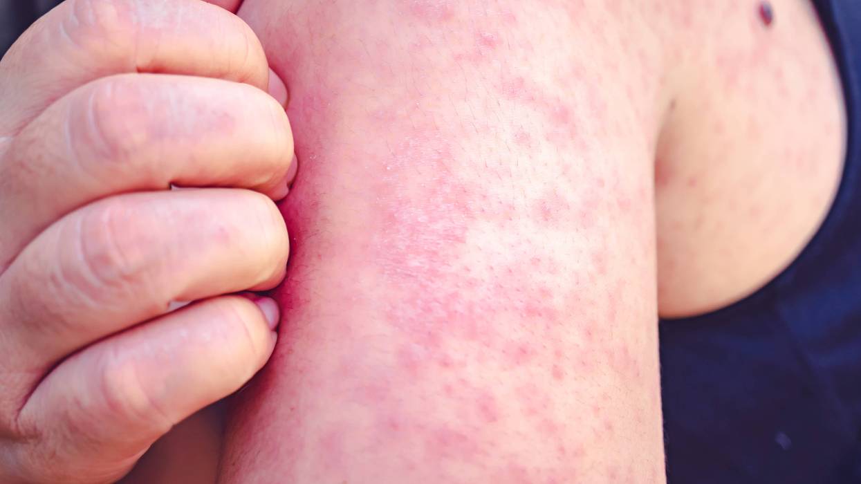 Stock photo of rash from measles