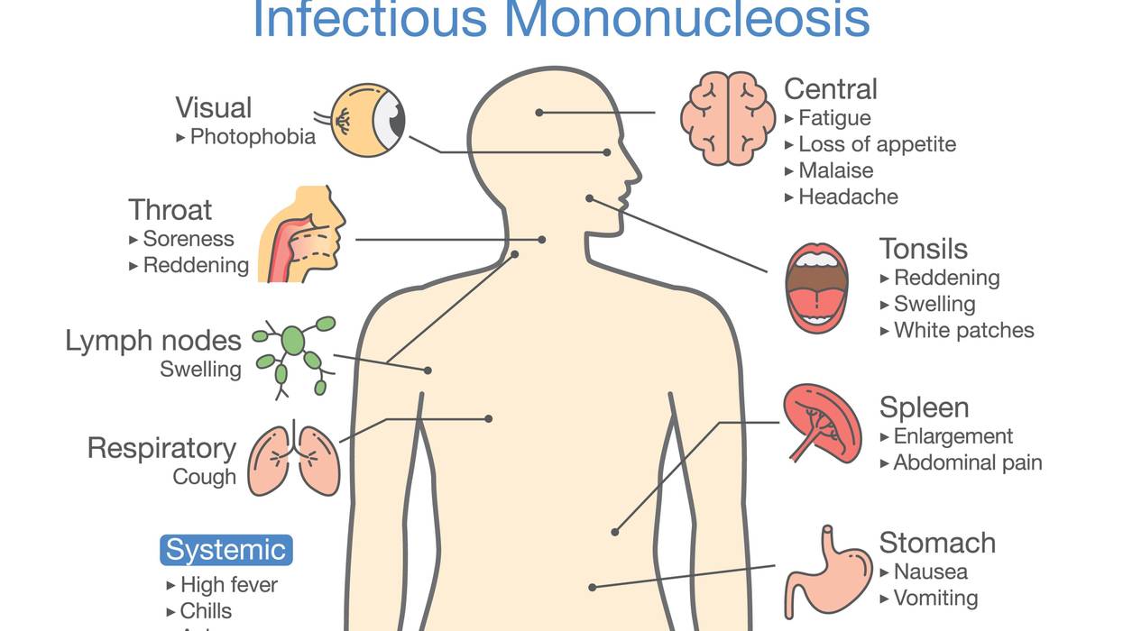 Symptoms of mononucleosis