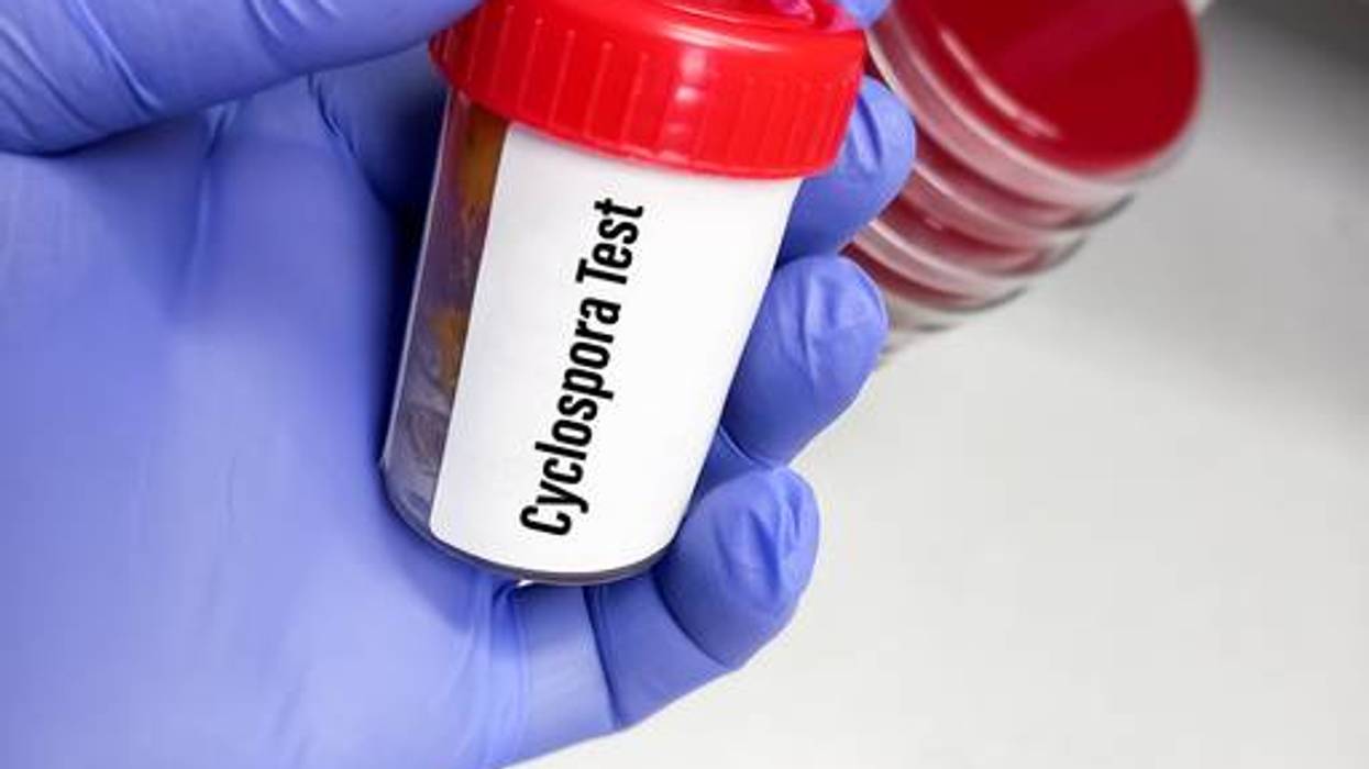 Cases of cyclosporiasis increase to 1,562 in Michigan, including 44 people who were hospitalized