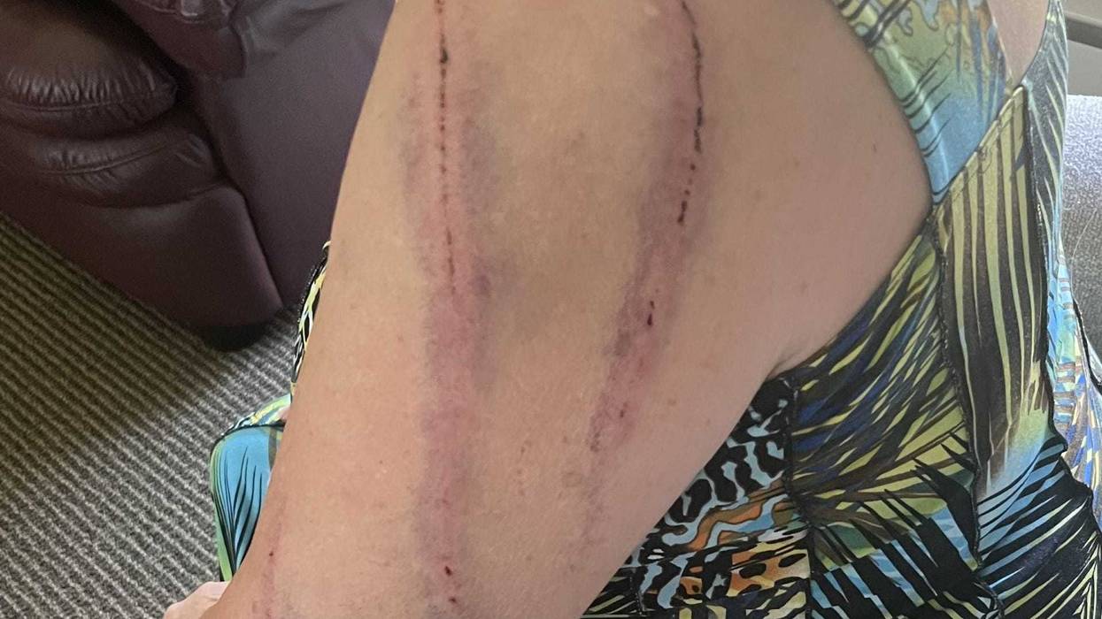 The Minneapolis woman attacked by a black bear.