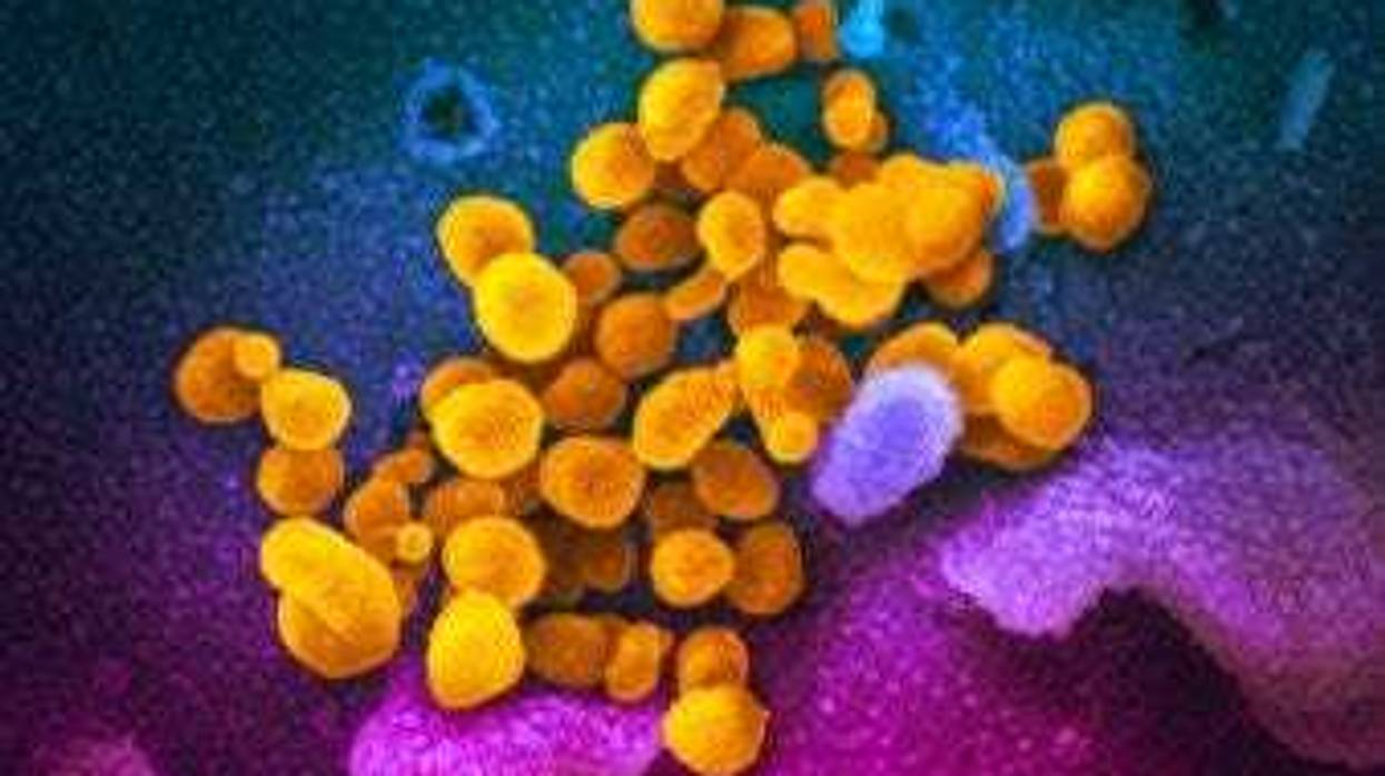This undated electron microscope image made available by the U.S. National Institutes of Health in February 2020 shows the Novel Coronavirus SARS-CoV-2, yellow, emerging from the surface of cells, blue/pink, cultured in the lab. (NIAID-RML via AP)