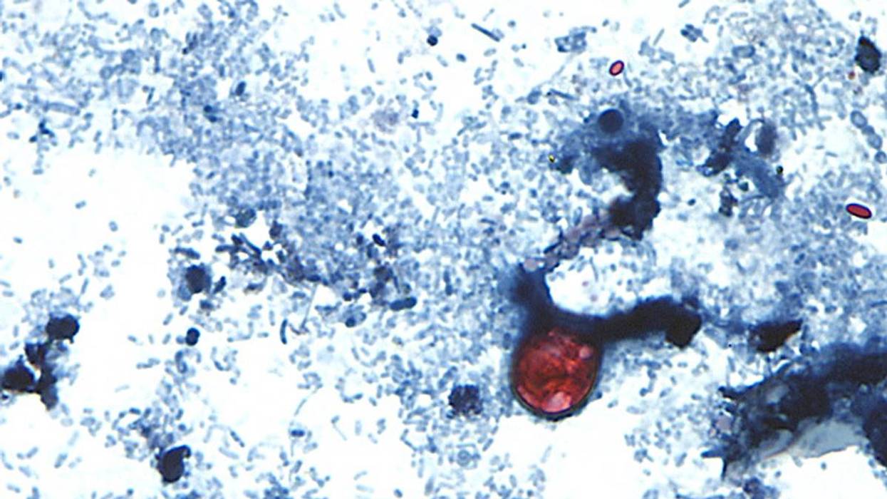 NY sees rising cases as parasite that causes severe diarrhea spreads across Midwest