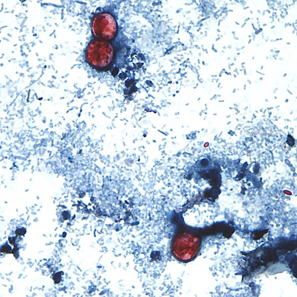 NY sees rising cases as parasite that causes severe diarrhea spreads across Midwest