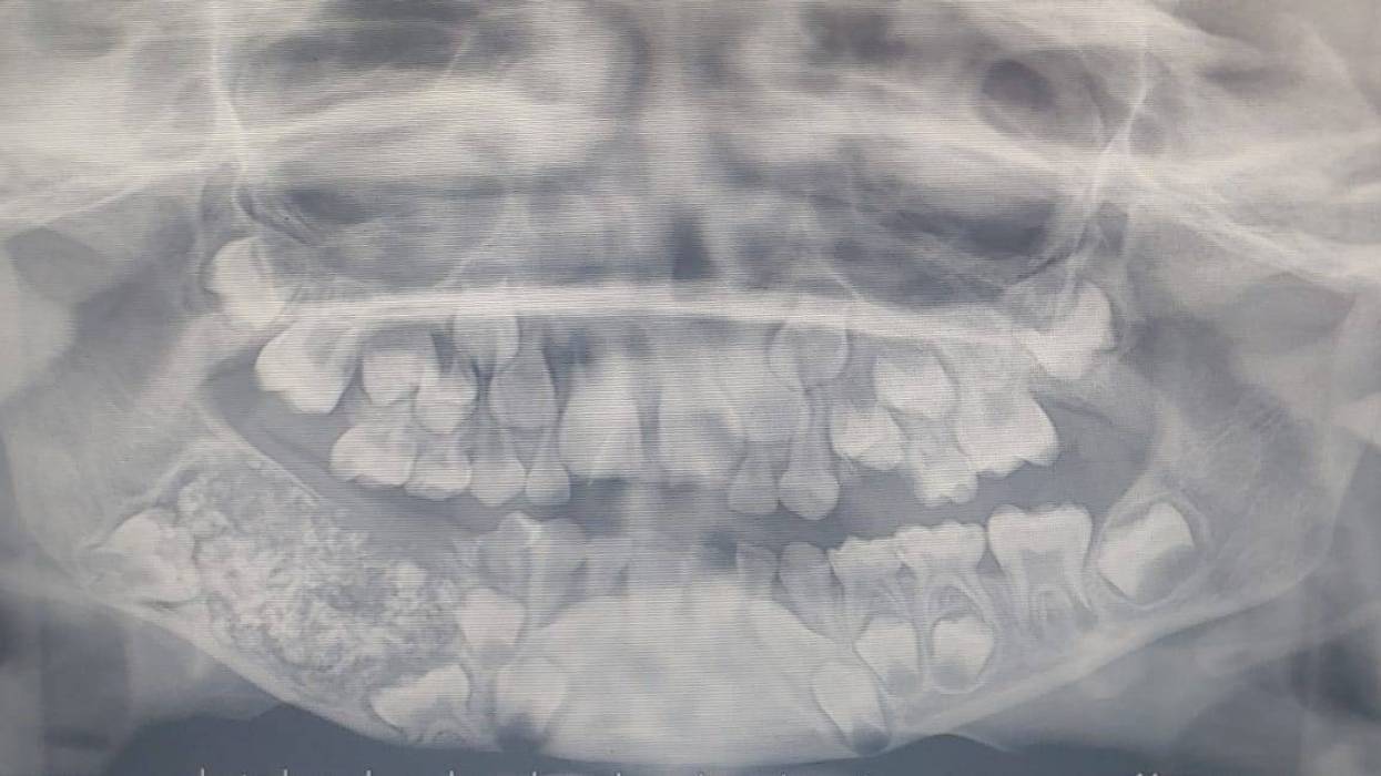 This x-ray shows the inside of the mouth of a boy who was found to have an extra 526 teeth. Credit: Saveetha Dental College and Hospital