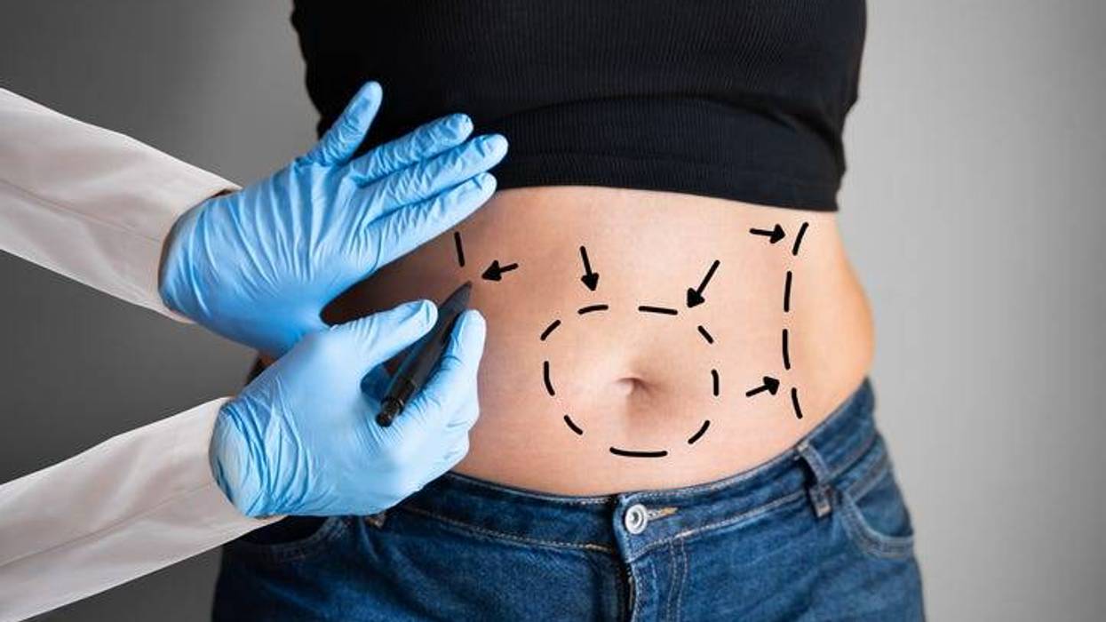 Tummy tuck