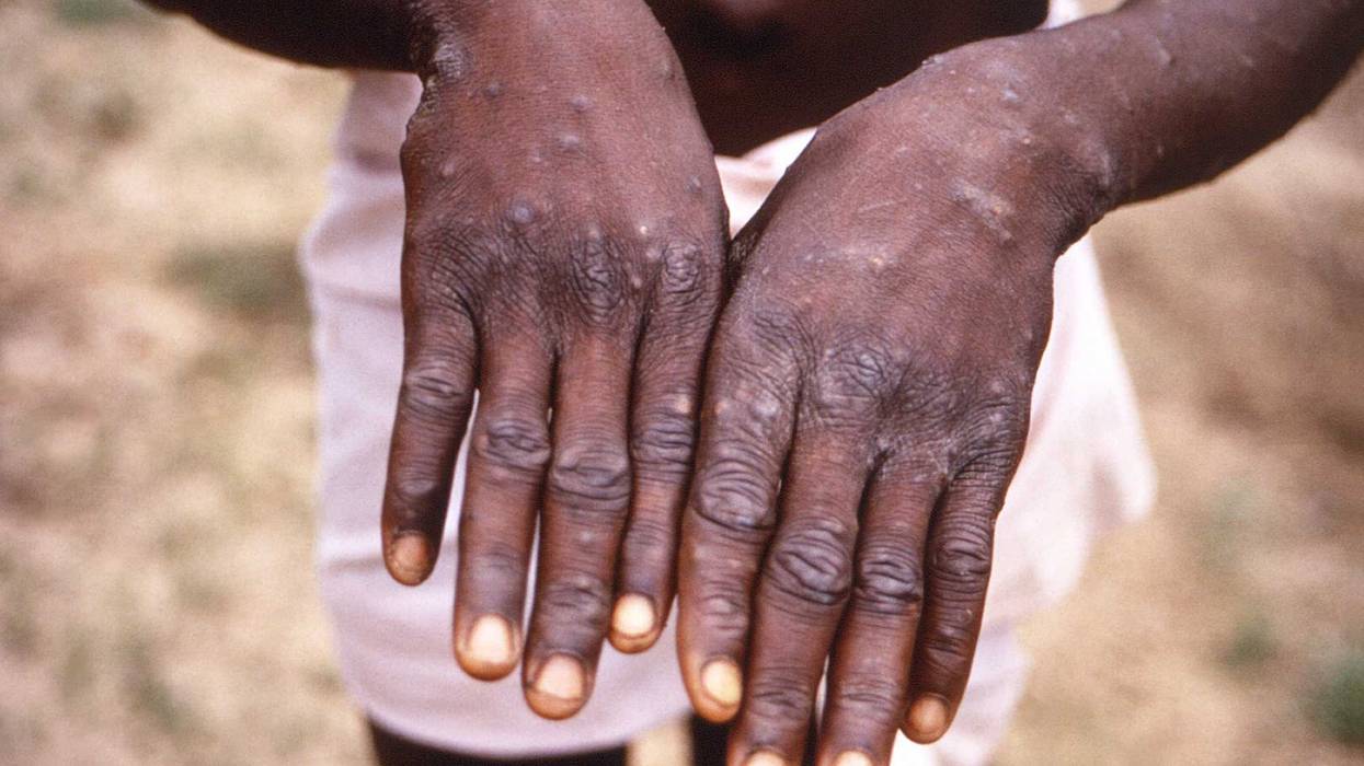 WHO Monkeypox