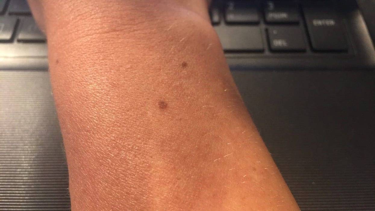 Wrist Freckle