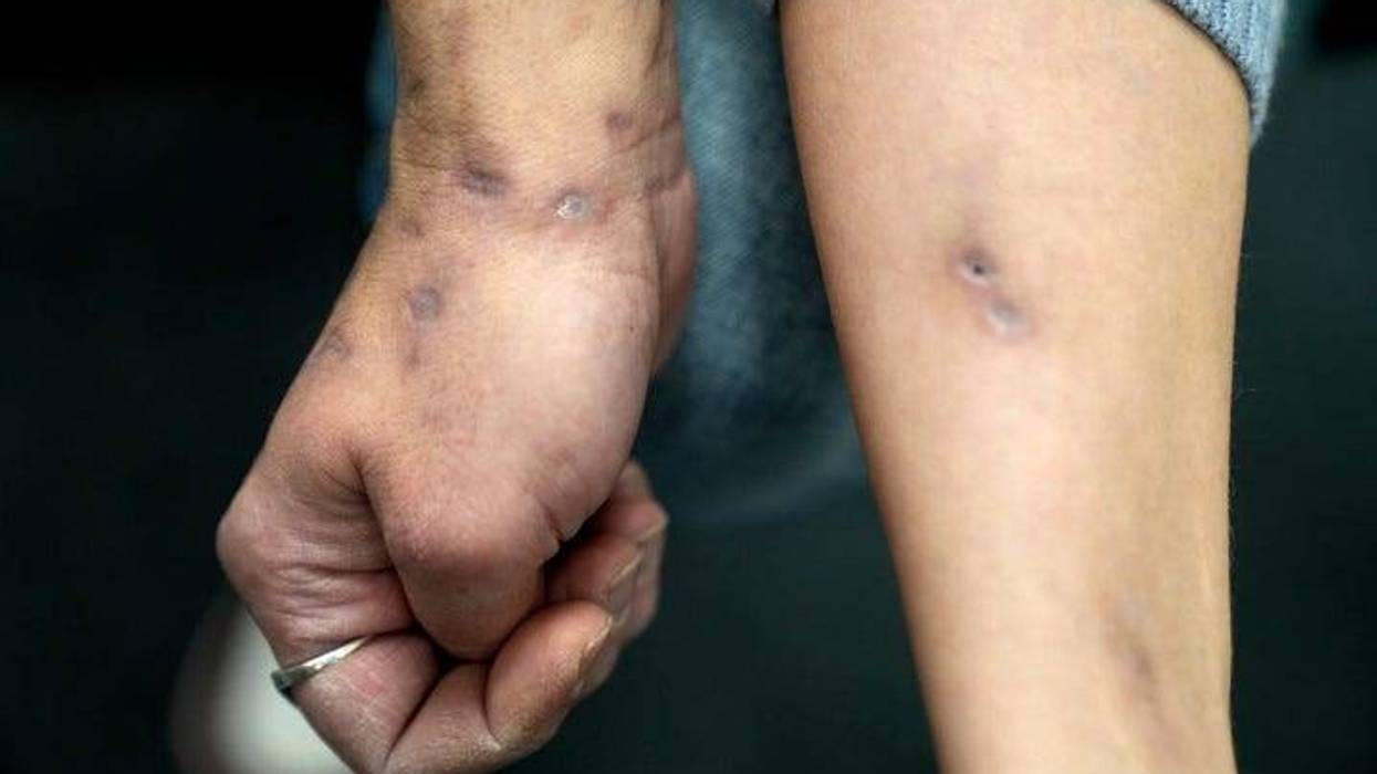 Xylazine-induced lesions cover a woman's arms and other parts of her body.